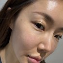 샤인성형외과 | 신사역성형외과 수면쥬베룩 스킨부스터 4주차 후기 (통증, 효과, 부작용)