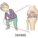 고관절염, 원인. 증상. 진단. 치료 이미지