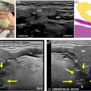 1. Neck Level I: Submental (IA) and submandibular (IB) levels 이미지