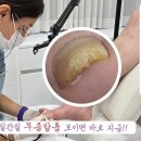 1년 전부터 발이 간질간질하고 발톱이 점점 누래지셔서 고생하시던 남성고객님.. 발톱무좀 완벽 관리해드렸어요 이미지