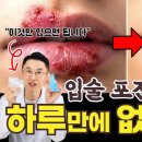 타이밍 놓치면 아시클로버 발라도 2주 동안 고생합니다 (입술포진) 이미지