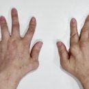 손가락 관절염 증상 류마티스 관절염 증상 (류머티스) 이미지