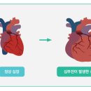 고혈압의 합병증 이미지