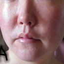 (주)브이써클메디칼 | 엑쎄라피 써클샷 5주차 후기