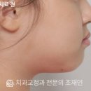 다정한치과의원 | 검단신도시 교정치과 | 앞니 벌어짐, 인비절라인 교정으로 1년 3개월 만에 예쁜 미소로 변화한 사례