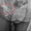 Pubis / 두덩뼈 / 치골 의 골절 및 통증. 이미지