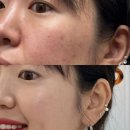 인천 부평 쥬브아셀 스킨부스터 손주사 후기 (+효과/통증/가격)