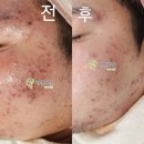 자연미인 | 중곡동 피부관리 에스테틱 염증성 여드름 관리 자연 미인 에스테틱에서 후기