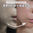피라고이불 | 연예인도 찾는 청담 하이엔드 내과에서 경험한 포톤테라피+맞춤 수액 피부 모낭염 개선 내돈내산 후기