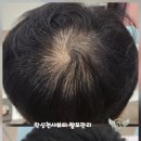 정화헤어타운 | ## **[수원 영화동 탈모관리] 비어가는 정수리·M자 탈모, 가리지 마세요! 과학적 모발 자생의 시간과...