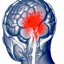 지나치기 쉬운 ‘뇌종양’ – 6가지 초기 증상과 예방법 및 추천식단 이미지
