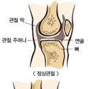 무지외반의 형태와 이런 저런 이야기 이미지