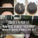 나폴리스튜디오헤어&속눈썹 | [일산 | 두피문신] 속눈썹펌 단골샵 *쉬즈해빙* 헤어라인·정수리 두피문신 3주 후기