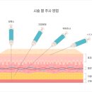 란 스킨