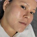 새안의원 | 강남역 피부과 울쎄쎄라300샷 가격 및 아픔후기