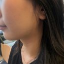 척메디칼 | 가양역피부과에서 온다리프팅 4만줄 이중턱 받아본 찐 후기