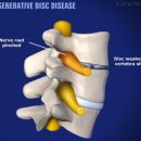 DEGENERATIVE DISC DISEASE-퇴행성 디스크 질환 이미지