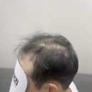 남자부분가발 30대 40대 남성 탈모 헤어 고민 후기