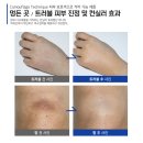 멍케어 이미지