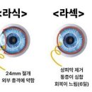 투데이 2DAY라섹 일반 라섹 스마일라식 차이 장담점 이미지