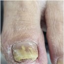 세븐일레븐 광주양산지구점 | 광주 첨단지구 발톱무좀 노란 발톱이 깨끗해졌어요! 루씨드네일샵 페디크루 광주북구점