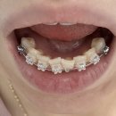 호박피씨 | [교정] 클린피씨 발치 교정 2달차, 월치료 2회차 후기, 치열 변화