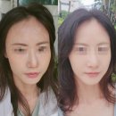 보림사우나 | 강남 땅콩형얼굴 중안면부축소 팔자주름 30대 실리프팅 멍붓기 화장