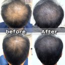 미헤어드림 | [부산 기장] 다트미 :: 정관 smp두피커버, 부산 정수리 민머리 가르마 헤어라인 탈모커버 잘하는 곳 추천