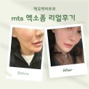 역곡역 | 역곡역피부과 mts 엑소좀 리얼후기! 전후 사진 비교