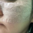 루비성형외과의원 | 압구정 &#34;라움성형외과&#34; 흑자 루비레이저 편평사마귀 제거 후기 / feat, 대기의 끝판왕