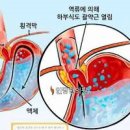 역류성식도염 진단 원인 역류성식도염에 좋은음식 이미지