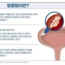 방광암 증상 생존율 원인 예방수칙 이미지