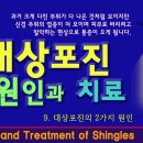 대상포진의 원인과 치료 방법들 이미지