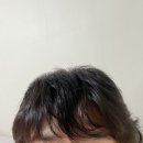 타인일치 100프로 이식 1년차 이미지