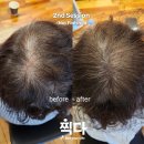 4050 정수리 탈모, 고민 해결 사연들 그리고 그 방법은?