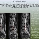 L4,5 번과 L5 - S1 Disc 가 bulging 된 환자입니다. 이미지