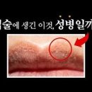 입술 포진 아시클로버 연고 이미지