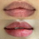 생기정 | 성남 분당 판교 어두운 입술 문신 탈각 후기 / 어두운 입술 타투 잘하는곳