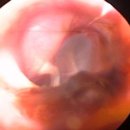 eardrum 이미지