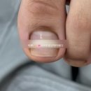 히쀼 [ 파주 문산문제성발톱 내성발톱교정_닥터페디&amp;네일투게더 / 2년 째 내돈내산 단골 후기 ]