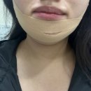 사과나무치과병원 | 후기 찾다가 광고뿐이라 내가 하고 직접 쓰는 기록.. 20대 임플란트 후기 (임플란트 뼈이식, 내돈내산...