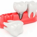 임플란트시술 진행과정은??? 이미지