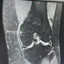 김동길 | 무릎 내측 측부인대 손상 파열 재활 운동 방법, 주차별 치료 방법