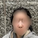 코재수술 내 돈 내산 일주일 후기 (용코 교정 비공 내리기 메부리코)