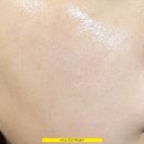 여드름 화장품 사용 후기 (좁쌀 피부 관리 성공)