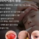 가와사키병 원인 증상 치료 아기 발진 고열 이미지