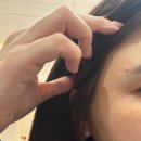 (주)부싼카센터 | 명동피부과 콜라겐주사 스킨부스터 올리디아 팔자주름 볼꺼짐 개선 전후 후기