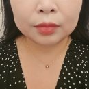 매직라인 | 여름 대비 얼굴 윤곽라인 관리 손유나클리닉 매직캣주사 1회차 후기!