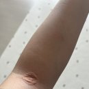 코뼈 부러졌을 때? 어디 병원으로 가야 할까? (송도 이비인후과 진료 후기)