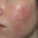365정화약국 | 티트리 성분, 모르고 그냥 바르면 피부 뒤집어집니다 (화상, 부작용 피하는 법)